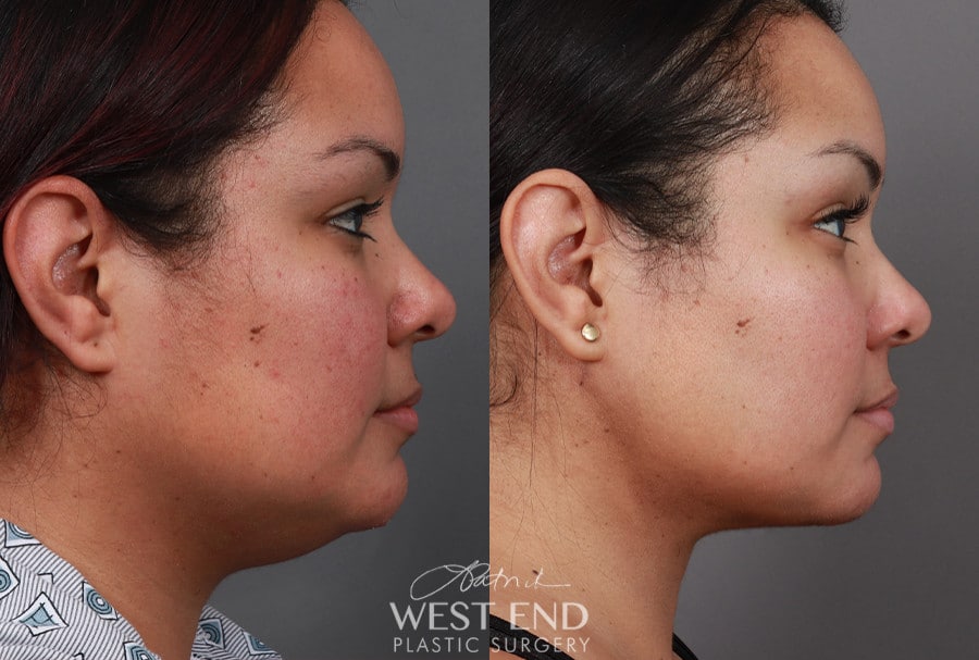 Submental Liposuction