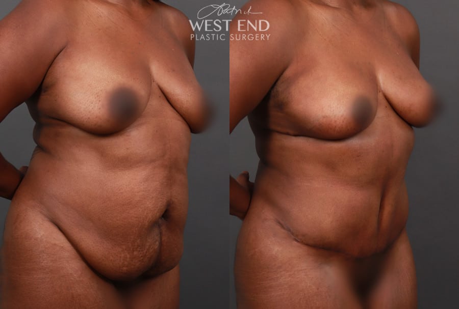 Tummy Tuck with Liposuction & Breast Lift