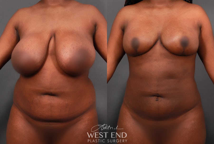 Breast Reduction & Liposuction