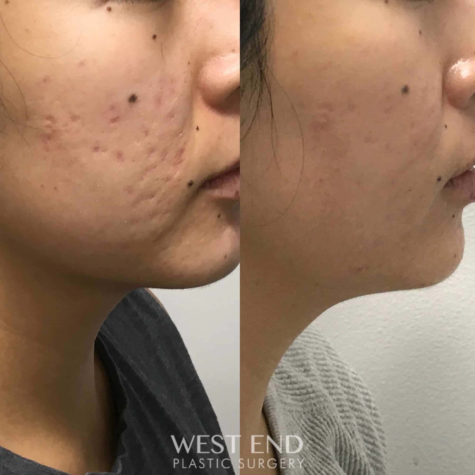 Microneedling with PRP for Acne Scars