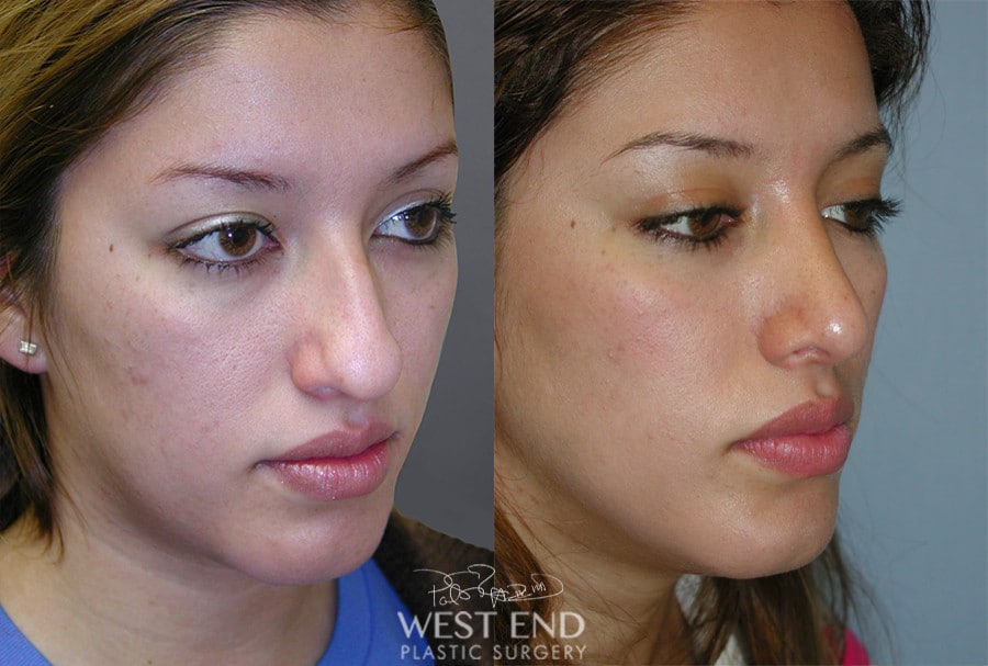 Rhinoplasty