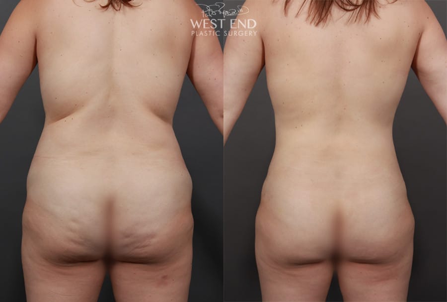 Vaser Liposuction & Buttock Dimple Release with Focused Fat Grafting