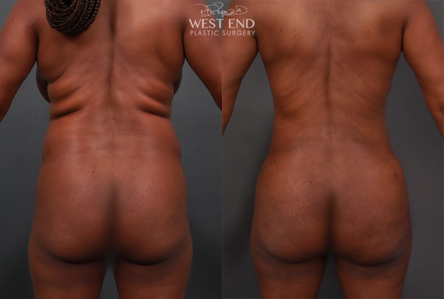 Liposuction, Renuvion Skin Tightening, and Brazilian Butt Lift
