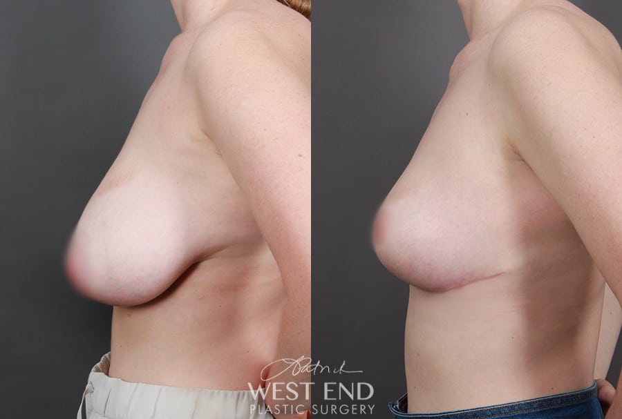 Breast Reduction
