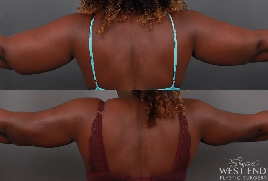 Liposuction and Renuvion Skin Tightening