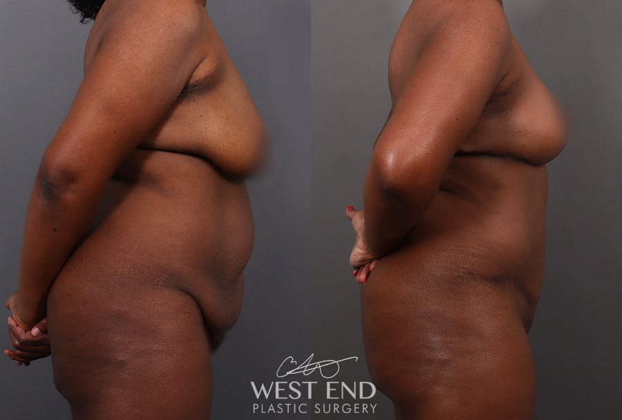 Mommy Makeover (Tummy Tuck & Breast Lift)