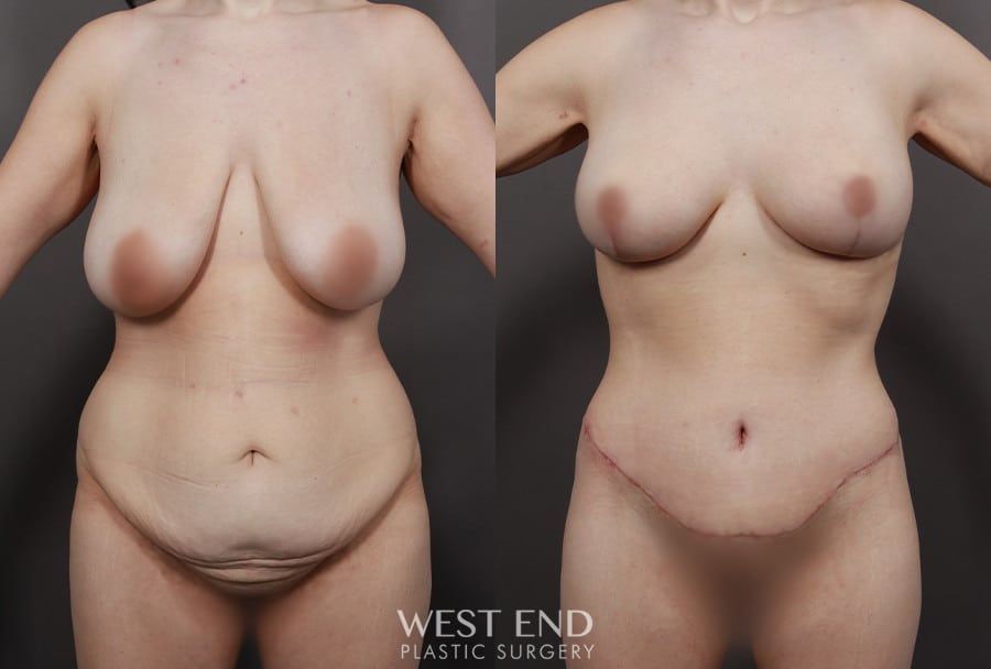 Post Weight Loss: Breast Lift, Tummy Tuck, Liposuction, & Renuvion Skin Tightening
