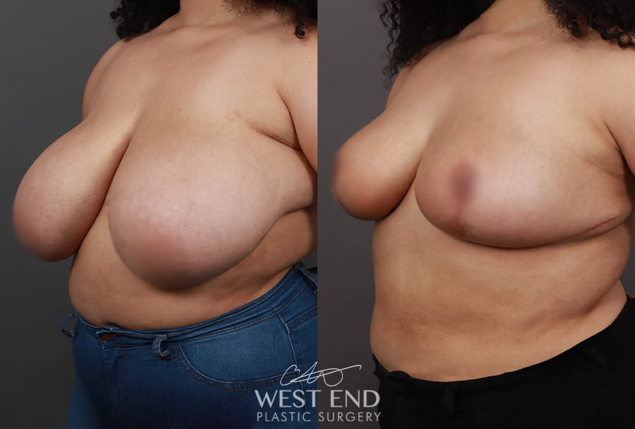 Breast Reduction