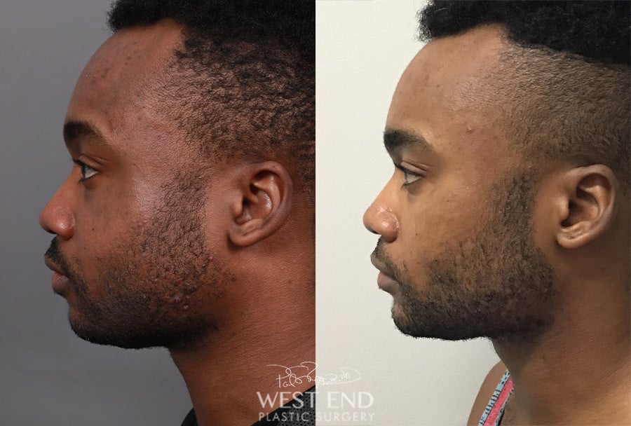 Liposuction & Buccal Fat Pad Removal