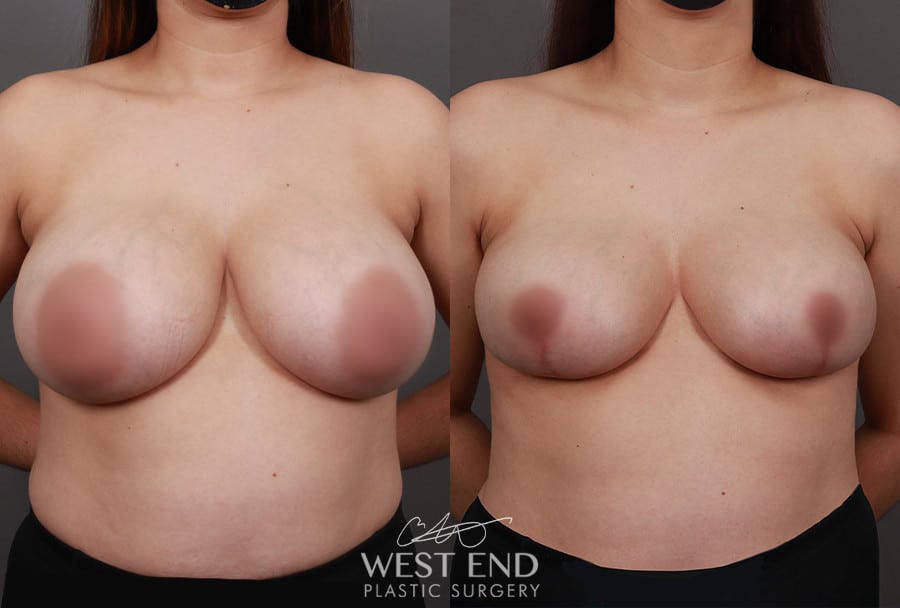 Breast Lift with Implant Exchange