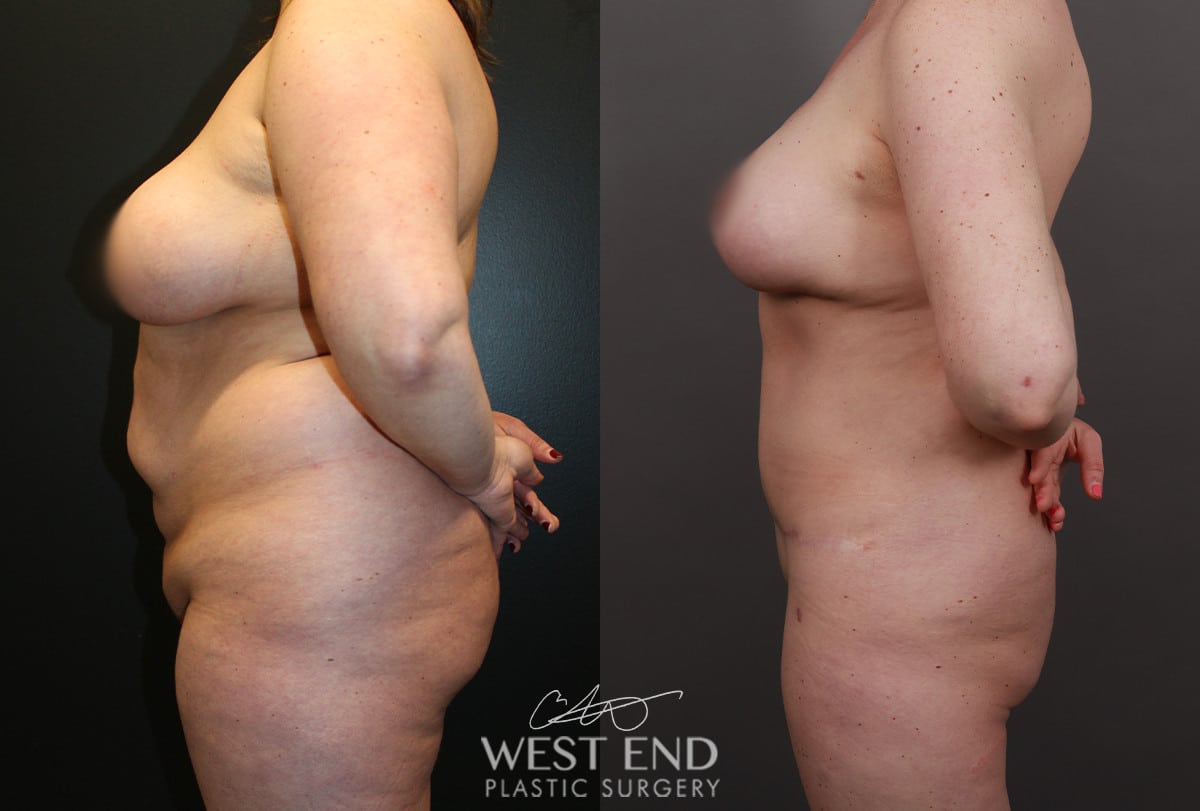 Tummy Tuck, Liposuction, Renuvion, and Breast Lift with Implant Exchange