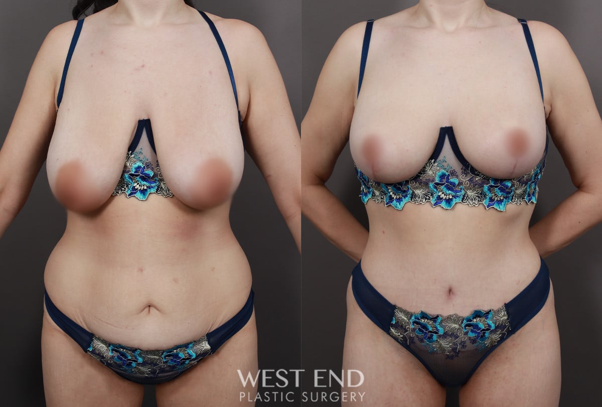 Post Weight Loss: Breast Lift, Tummy Tuck, Liposuction, & Renuvion Skin Tightening