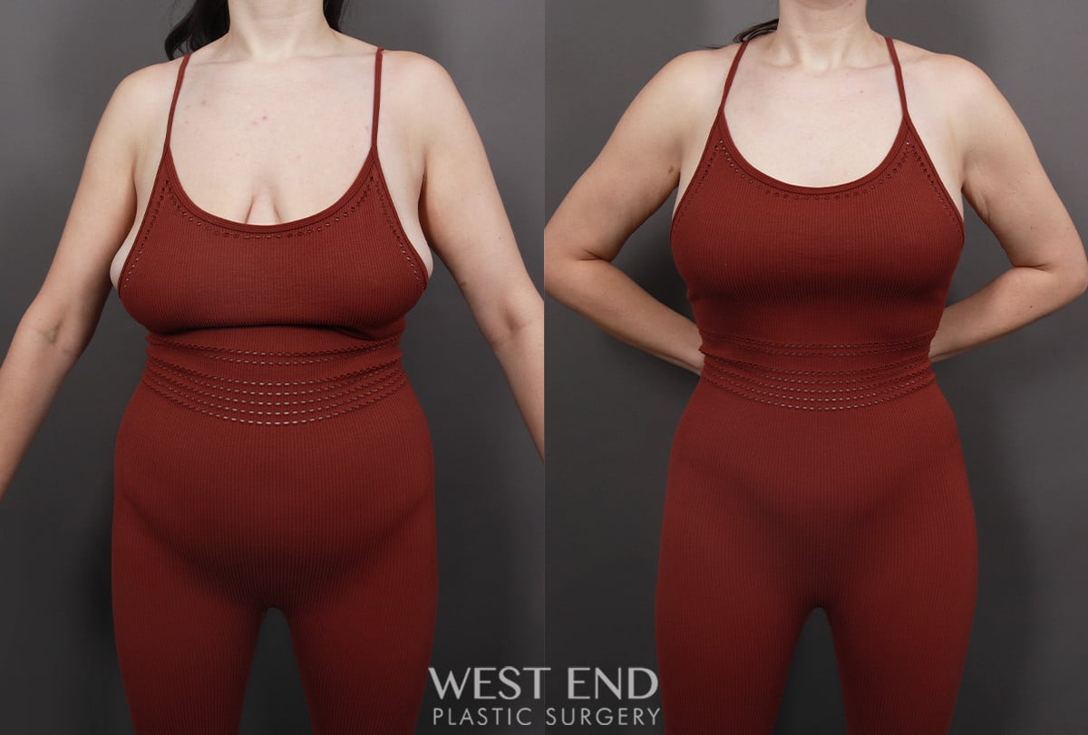 Post Weight Loss: Breast Lift, Tummy Tuck, Liposuction, & Renuvion Skin Tightening