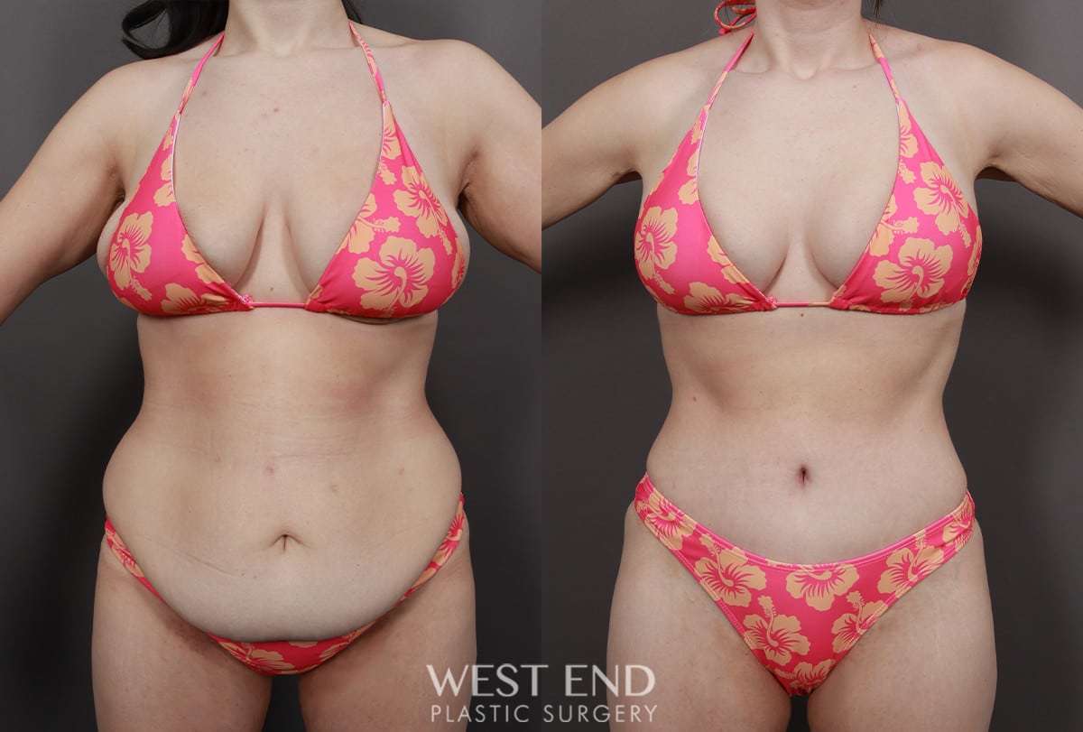 Post Weight Loss: Breast Lift, Tummy Tuck, Liposuction, & Renuvion Skin Tightening
