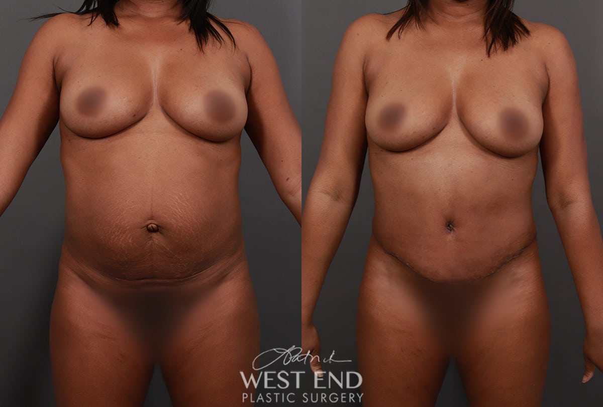 Tummy Tuck