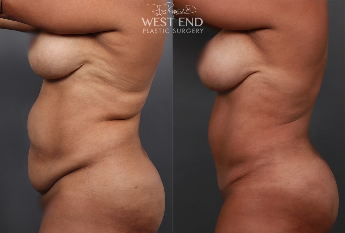 Tummy Tuck & Liposuction