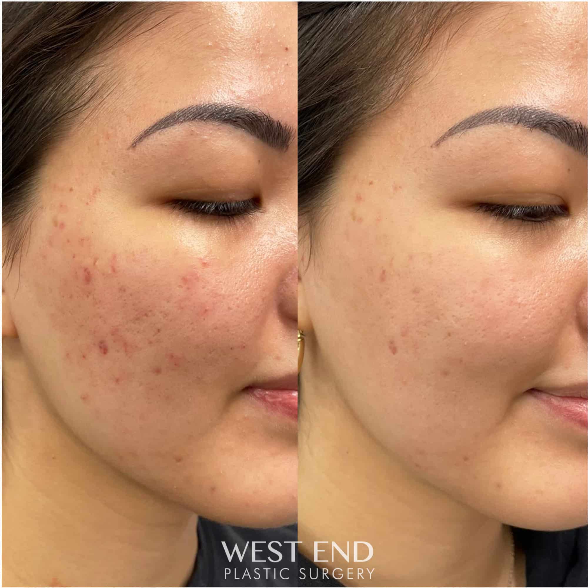Microneedling with PRP for Acne Scars