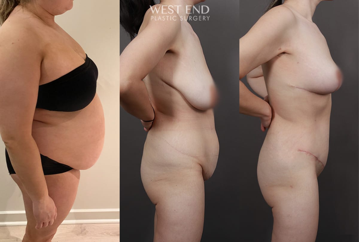 Post Weight Loss