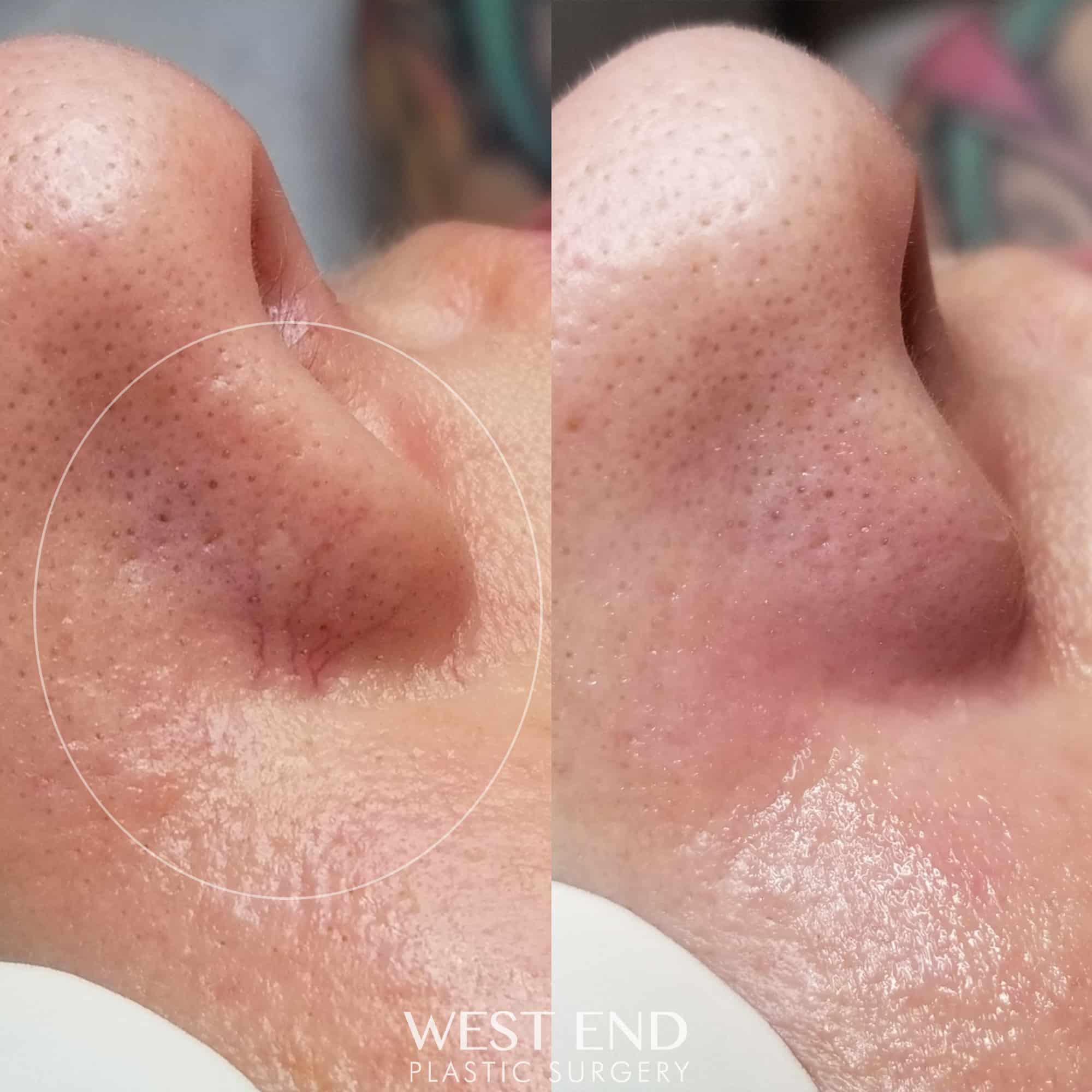 IPL (Vascular M22 Laser)