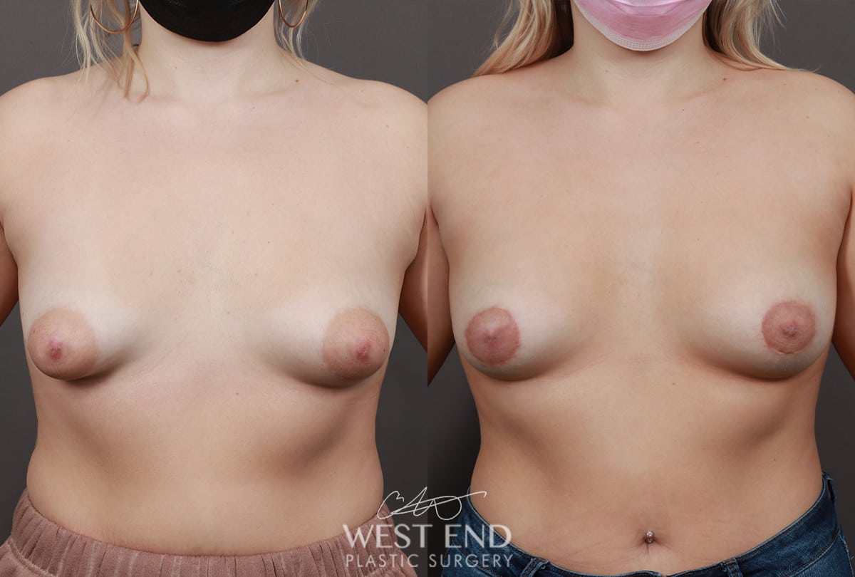 Areola Reduction
