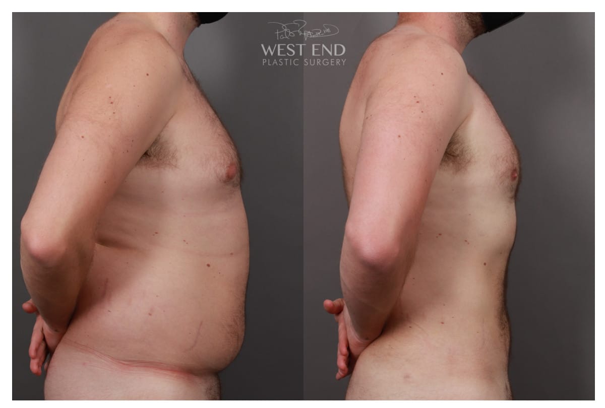 Liposuction and Renuvion Skin Tightening (4 Months Post-Op)