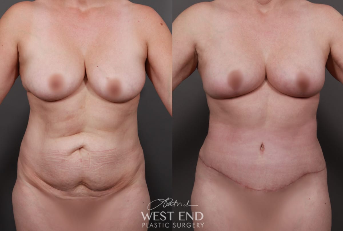 Tummy Tuck & Breast Lift with Fat Grafting