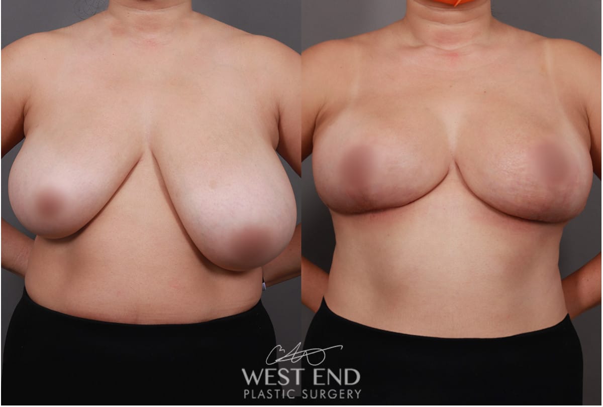 Breast Reduction