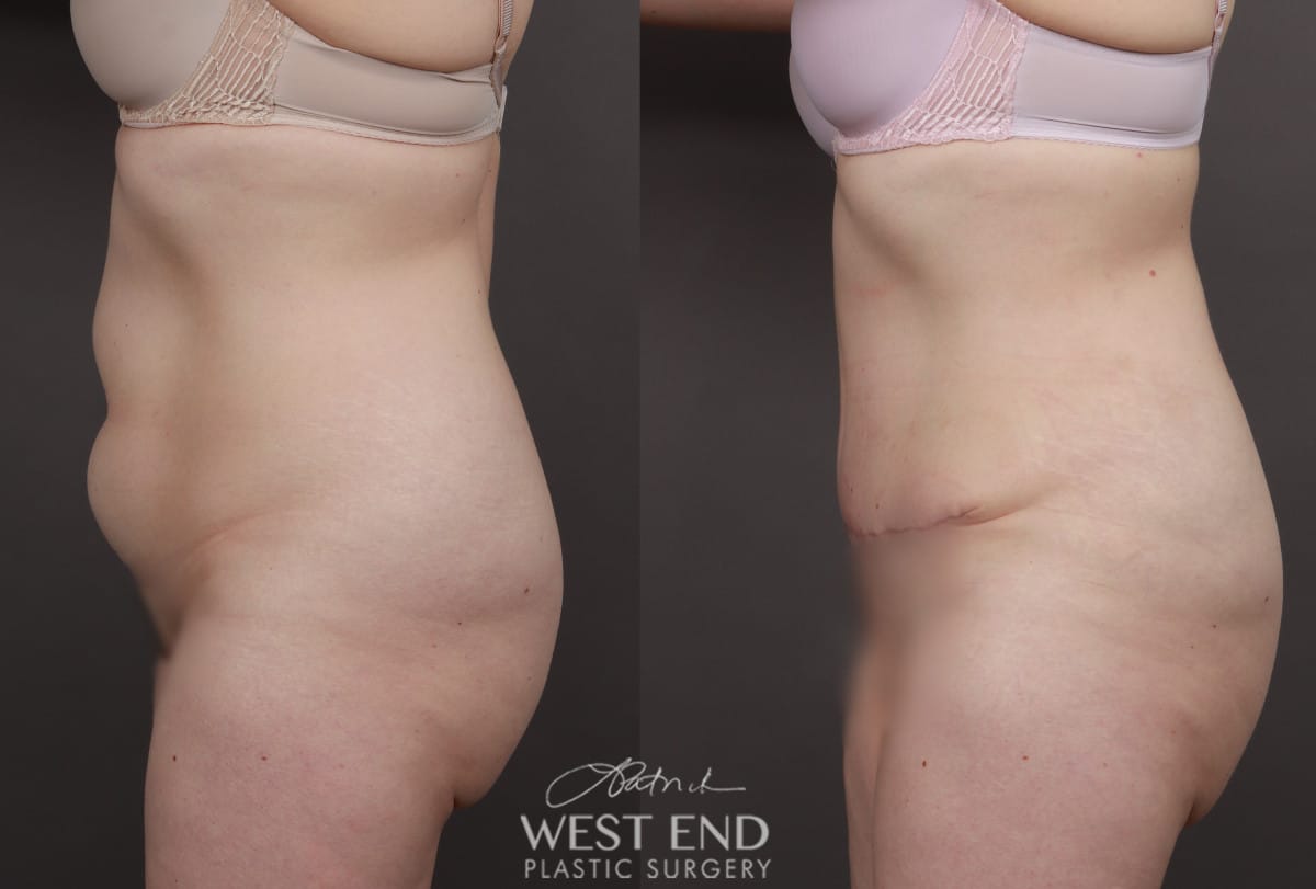 Tummy Tuck with Liposuction