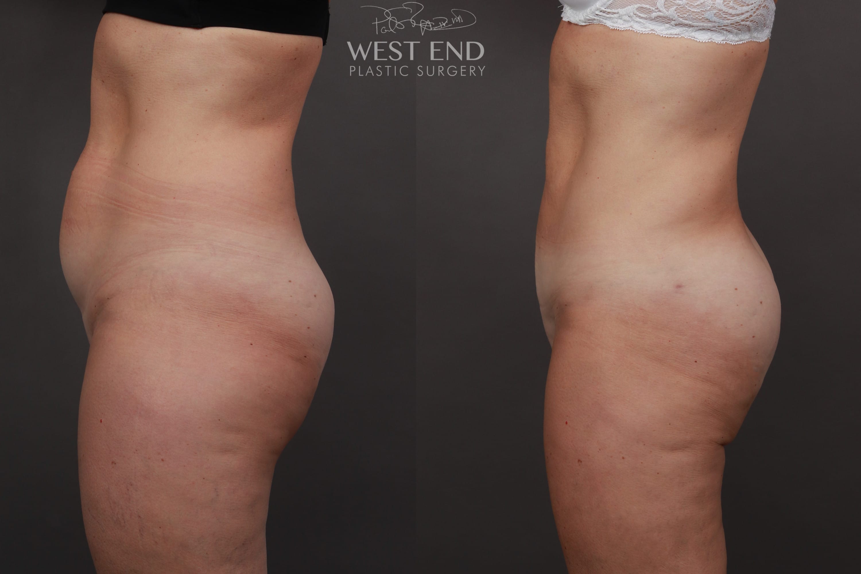 Liposuction & Renuvion Skin Tightening