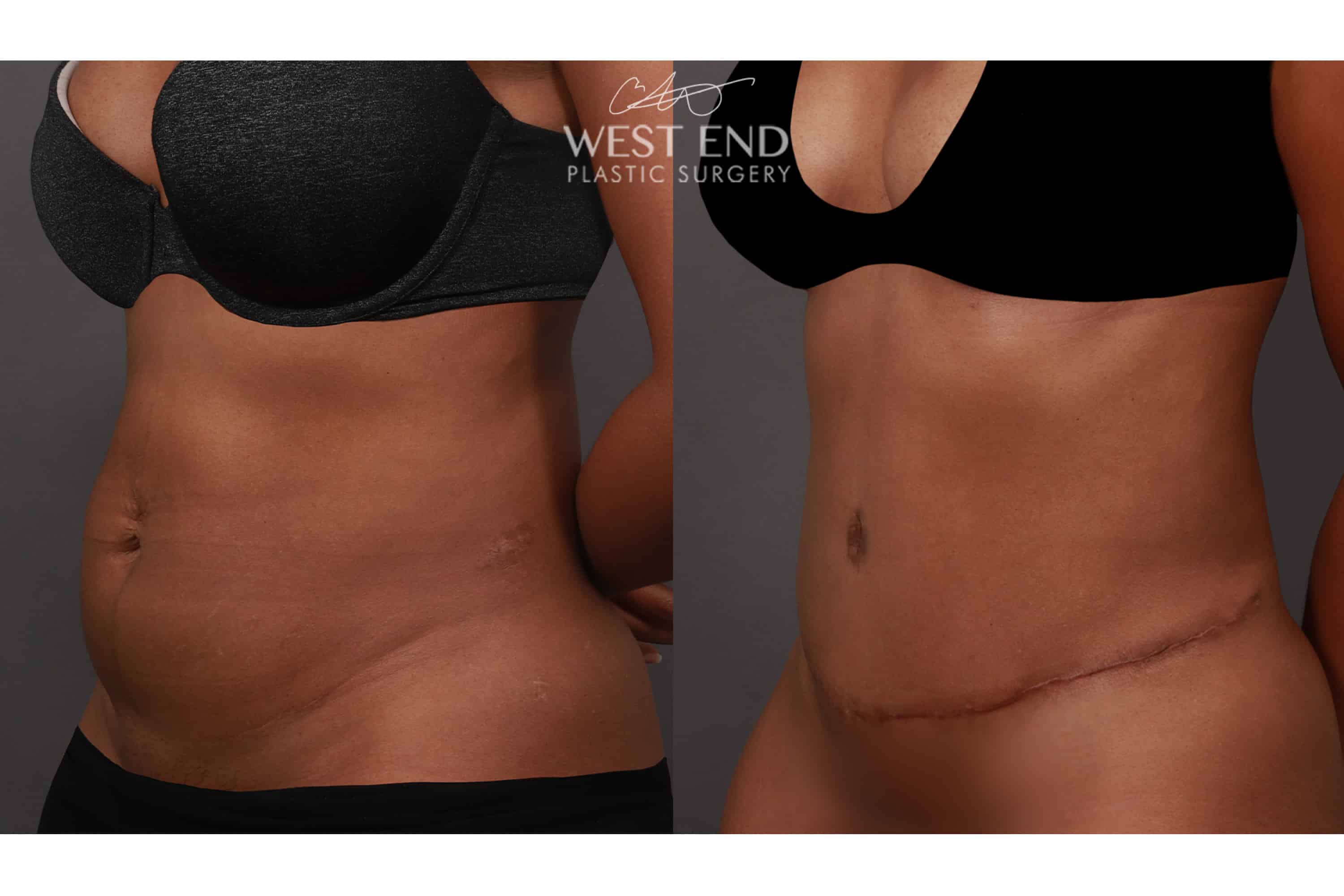 Mini Tummy Tuck