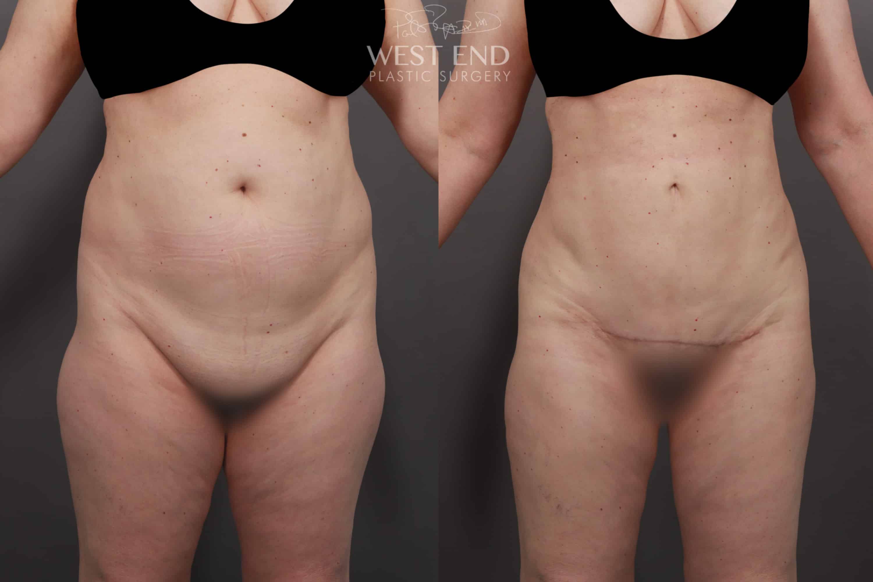 Mons Pubis Lift, Liposuction & Renuvion Skin Tightening