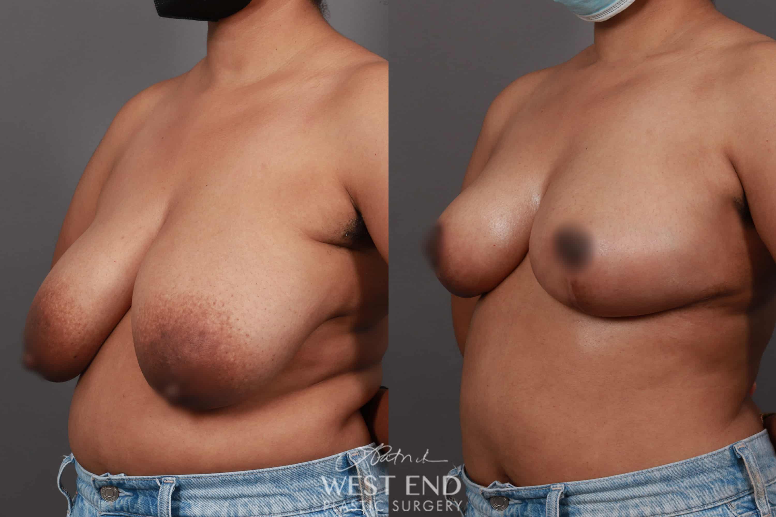 Breast Reduction (1 Month Post-op)