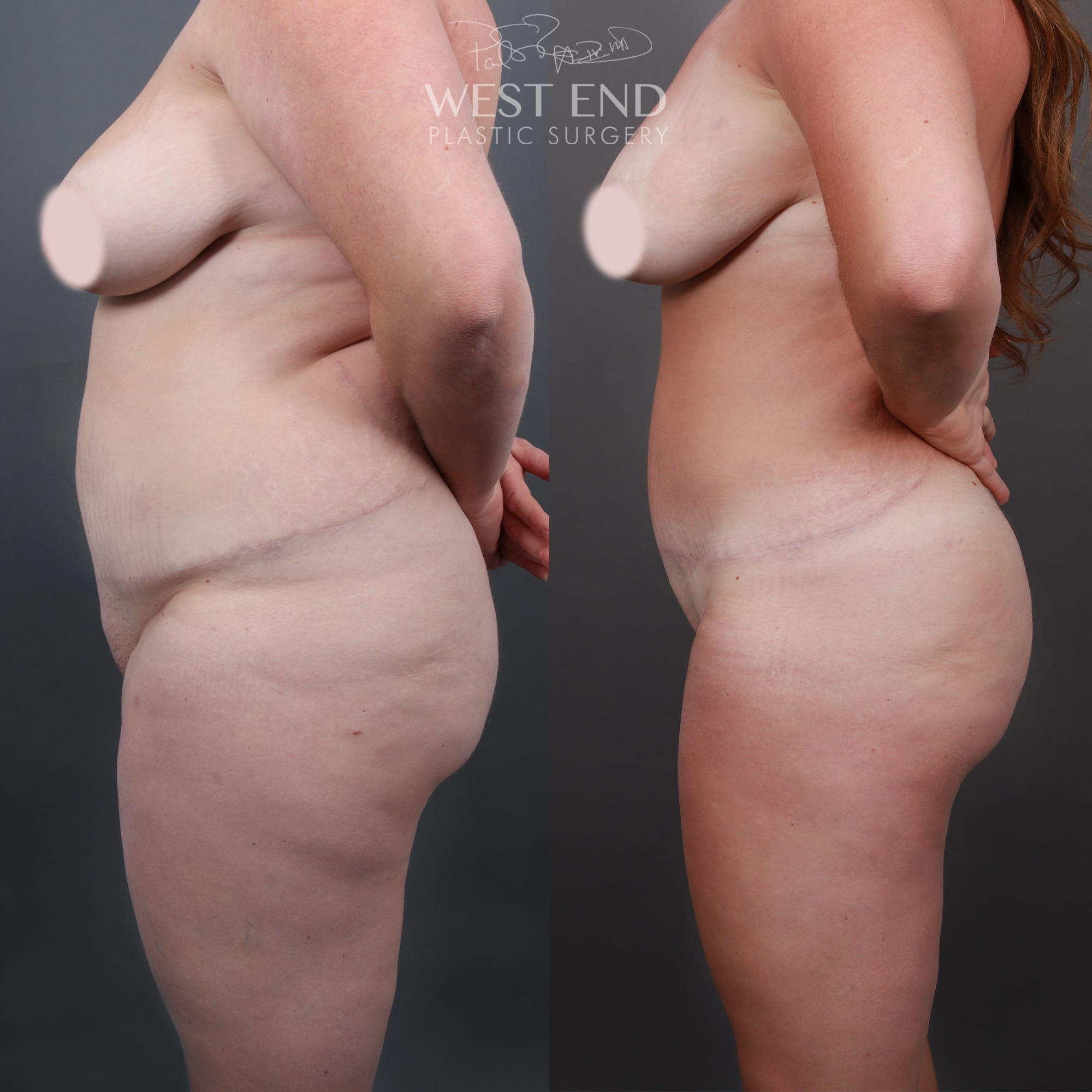 Liposuction & Brazilian Butt Lift