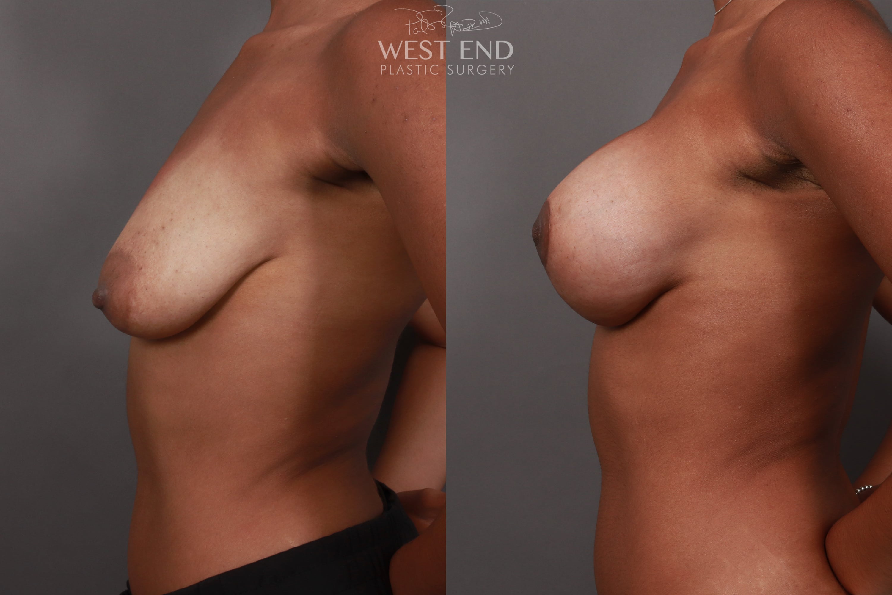 Breast Lift with Implants & Umbilical Hernia Repair