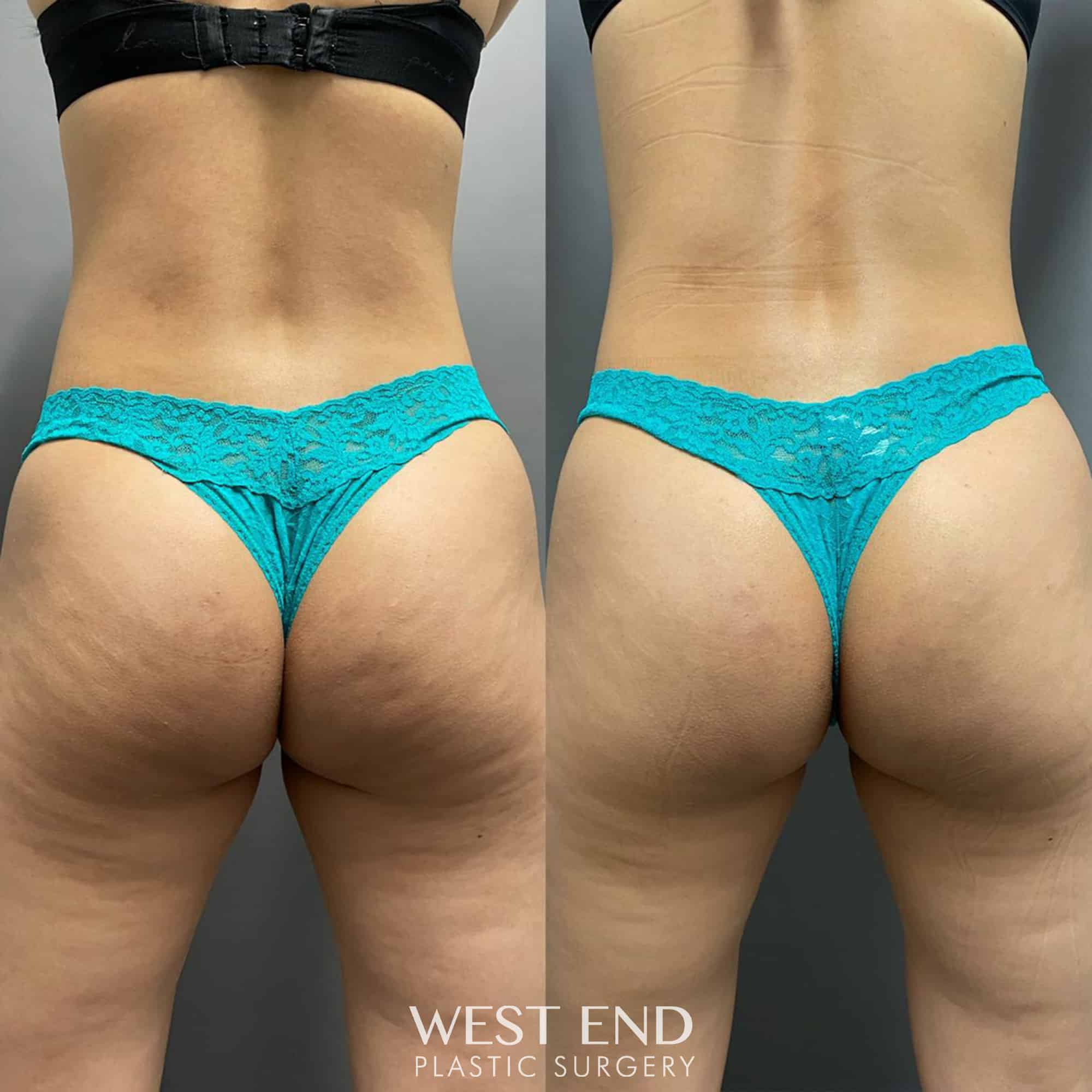 QWO (Injectable for Cellulite in Buttock)