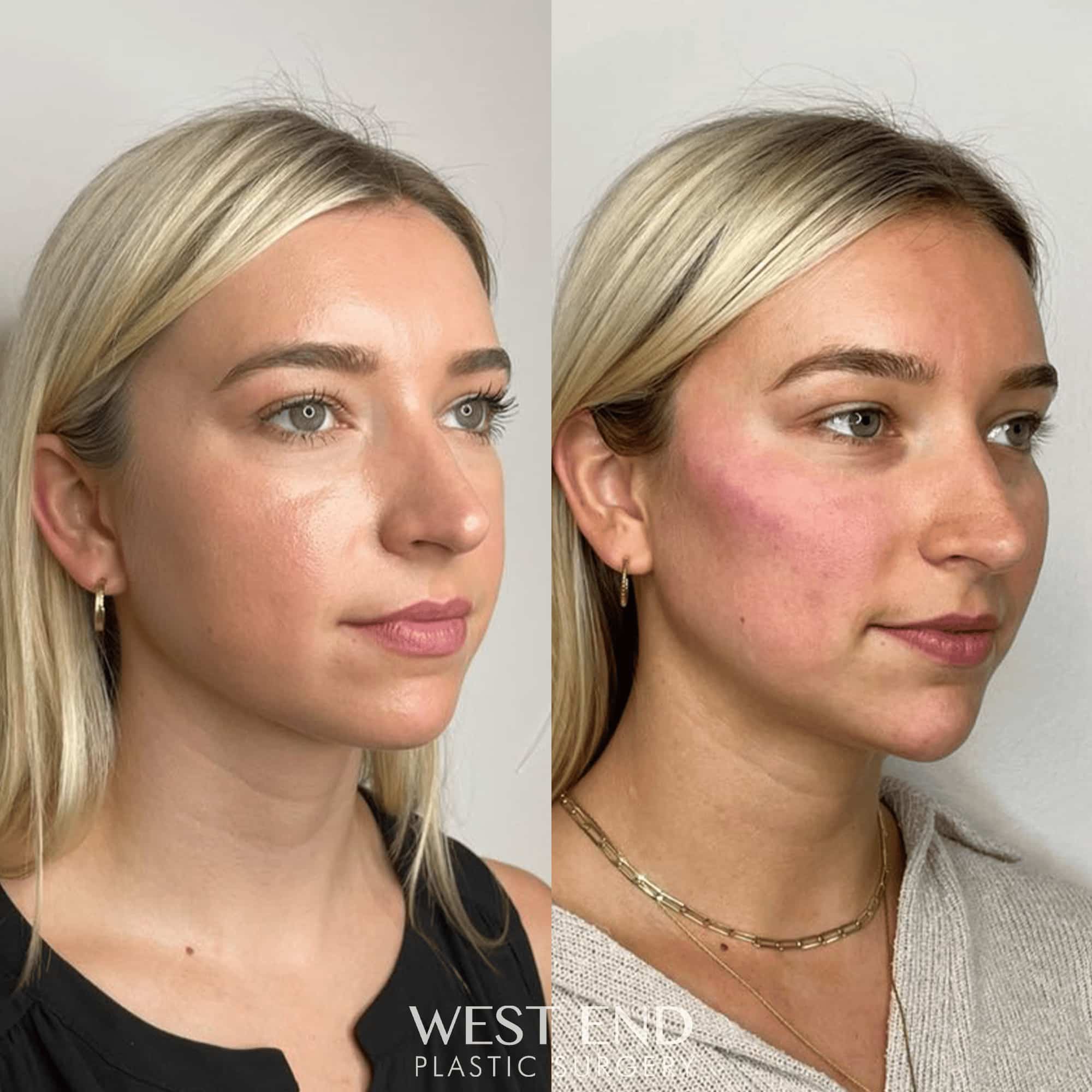 Cheek, Jawline, & Chin Filler