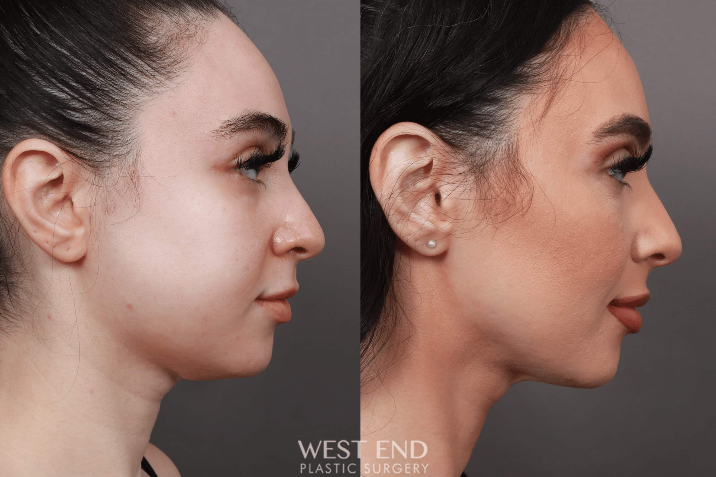 Liposuction of the Submental, Jawline, and Neck Region (5 Months Post-Op)