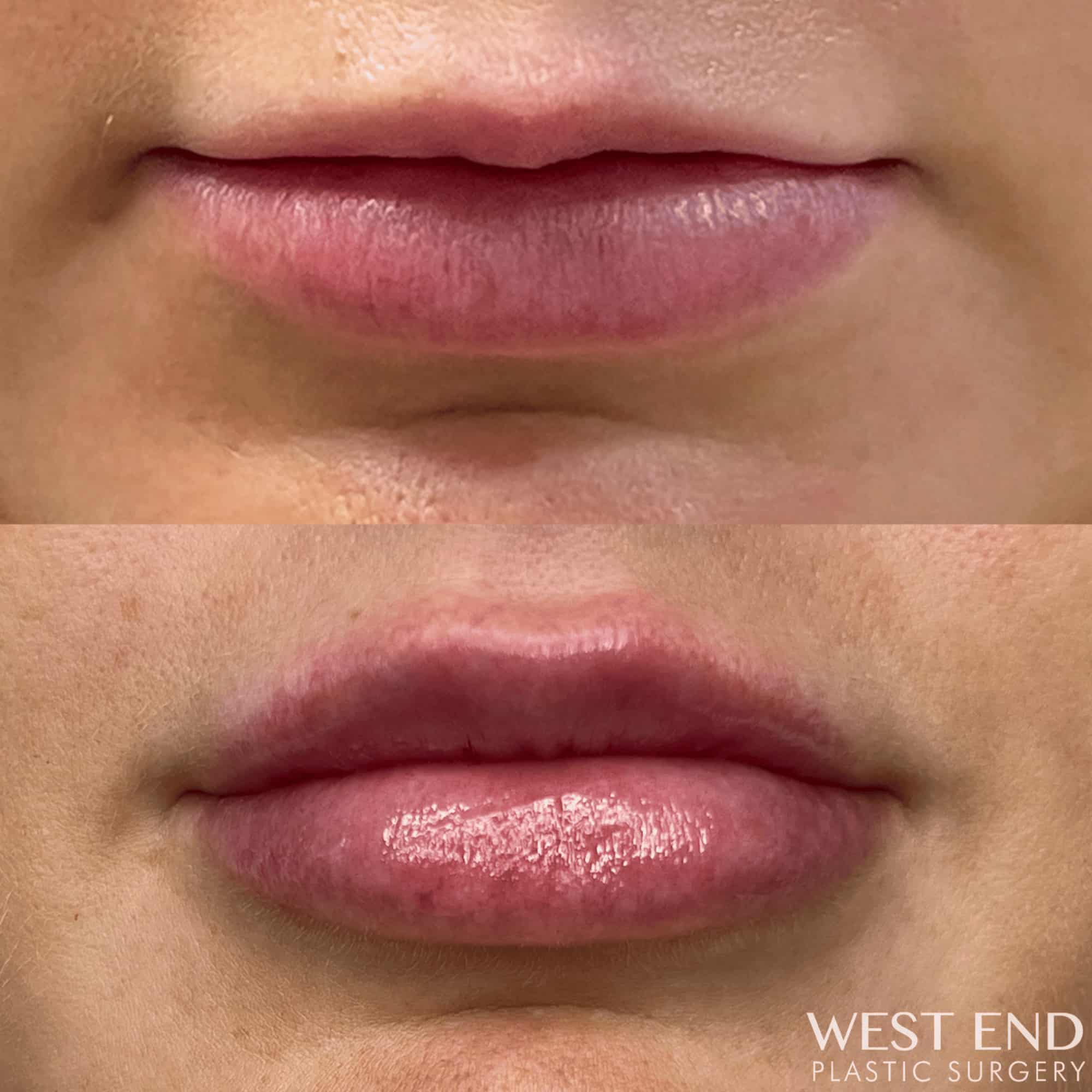 Lip Filler