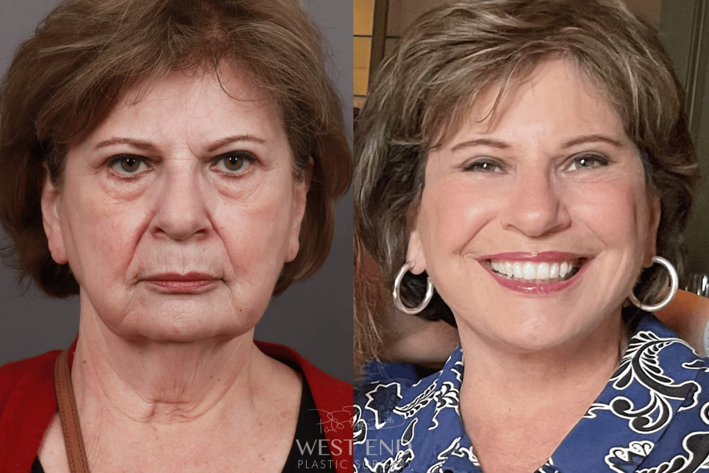 Deep Plane Facelift & Neck Lift, Brow Lift, Eyelid Lift, Fat Grafting, and CO2 Resurfacing (2.5 Months Post-Op)