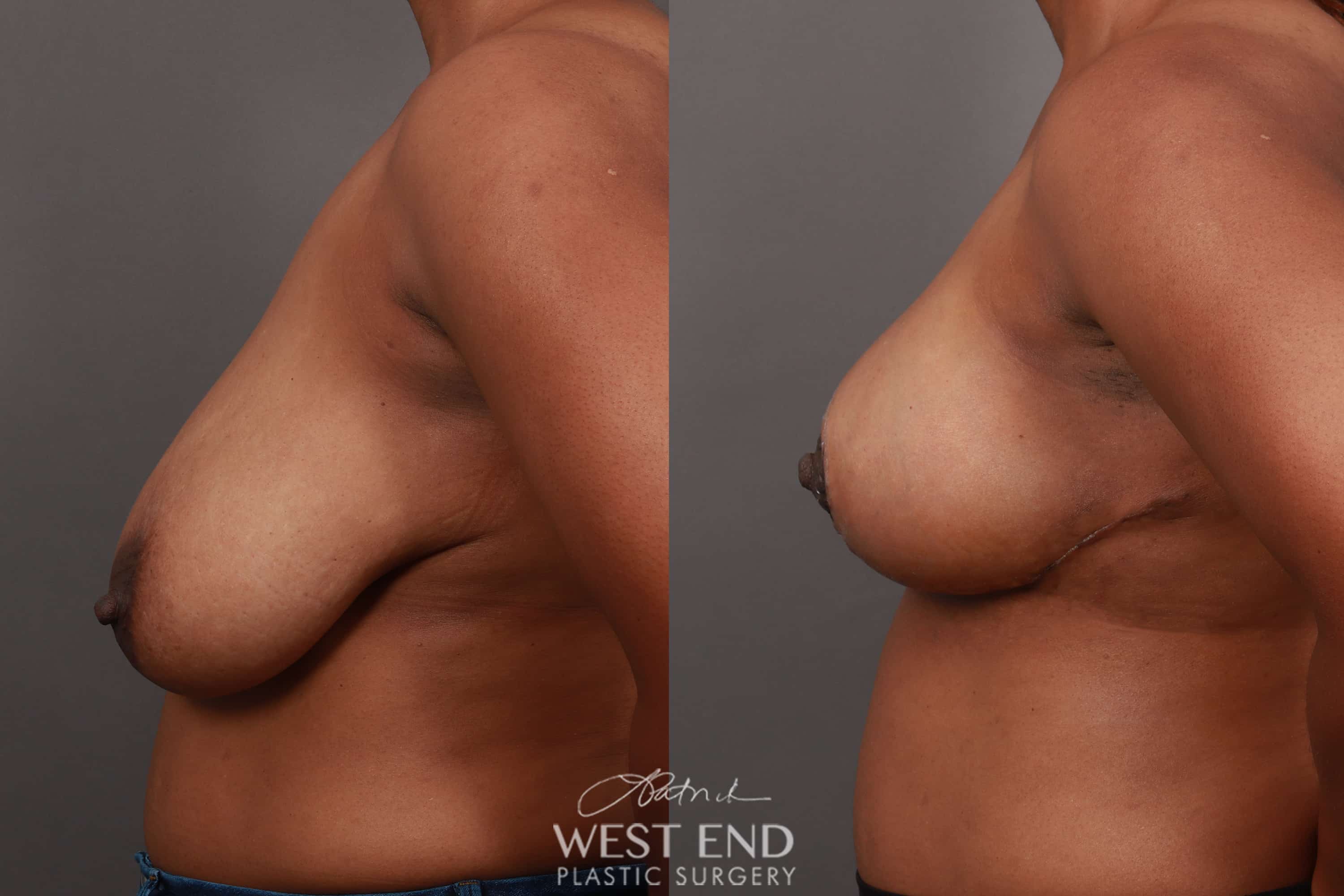 Breast Reduction (2 Weeks Post-Op)