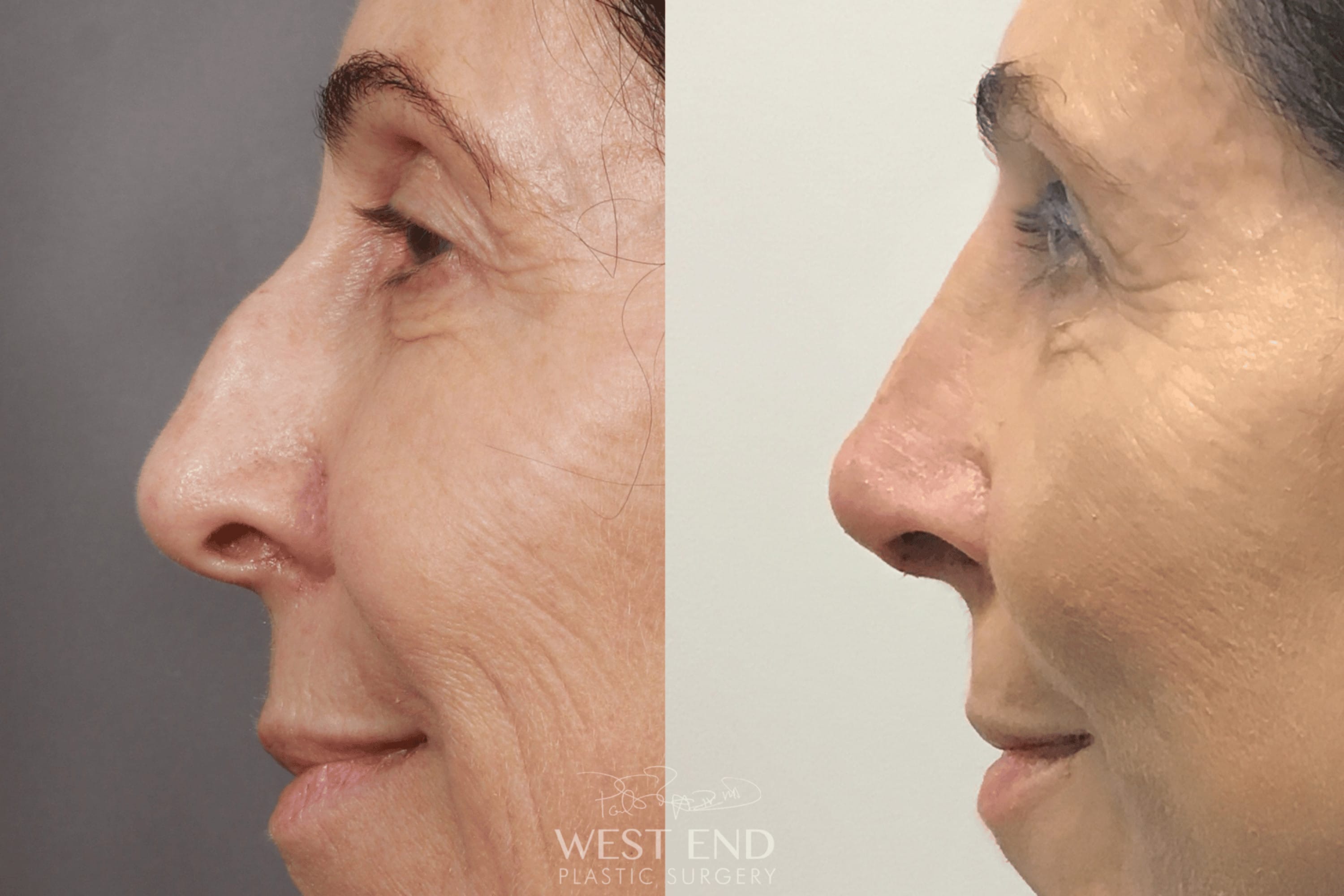 Rhinoplasty (9 Days Post-Op)