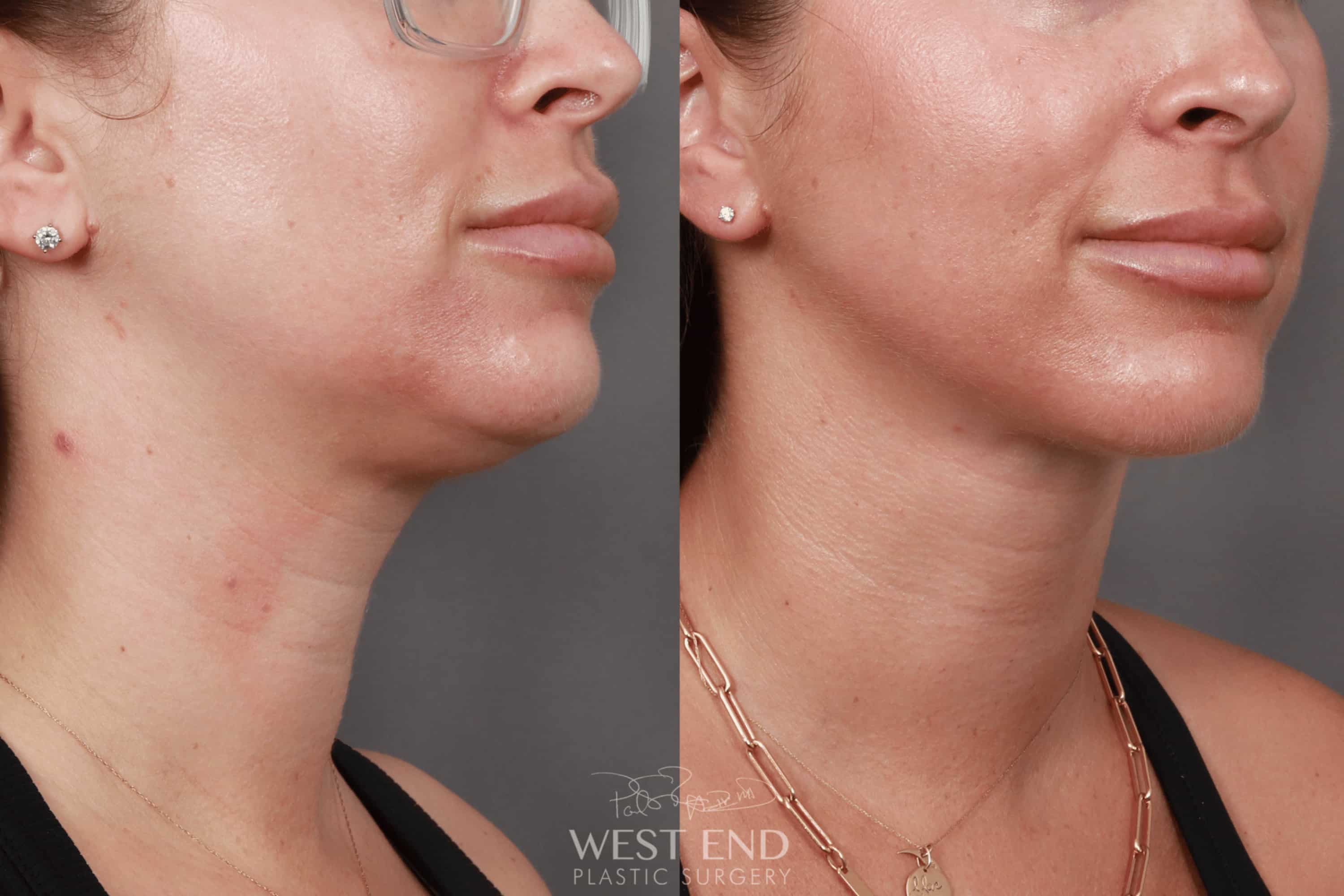 Liposuction of the Submental, Jawline, and Neck Region (5 Months Post-Op)