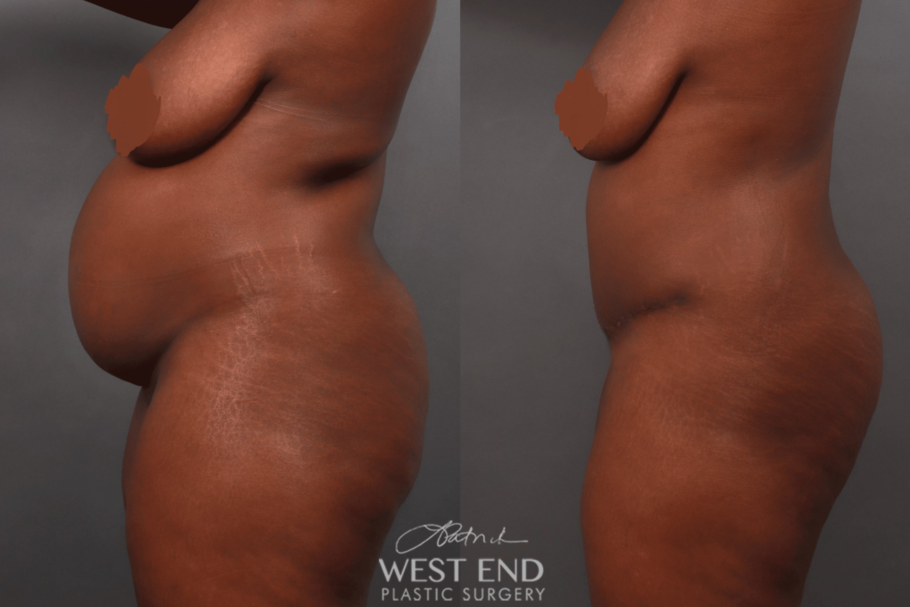 Tummy Tuck & Liposuction (1 Month Post-Op)