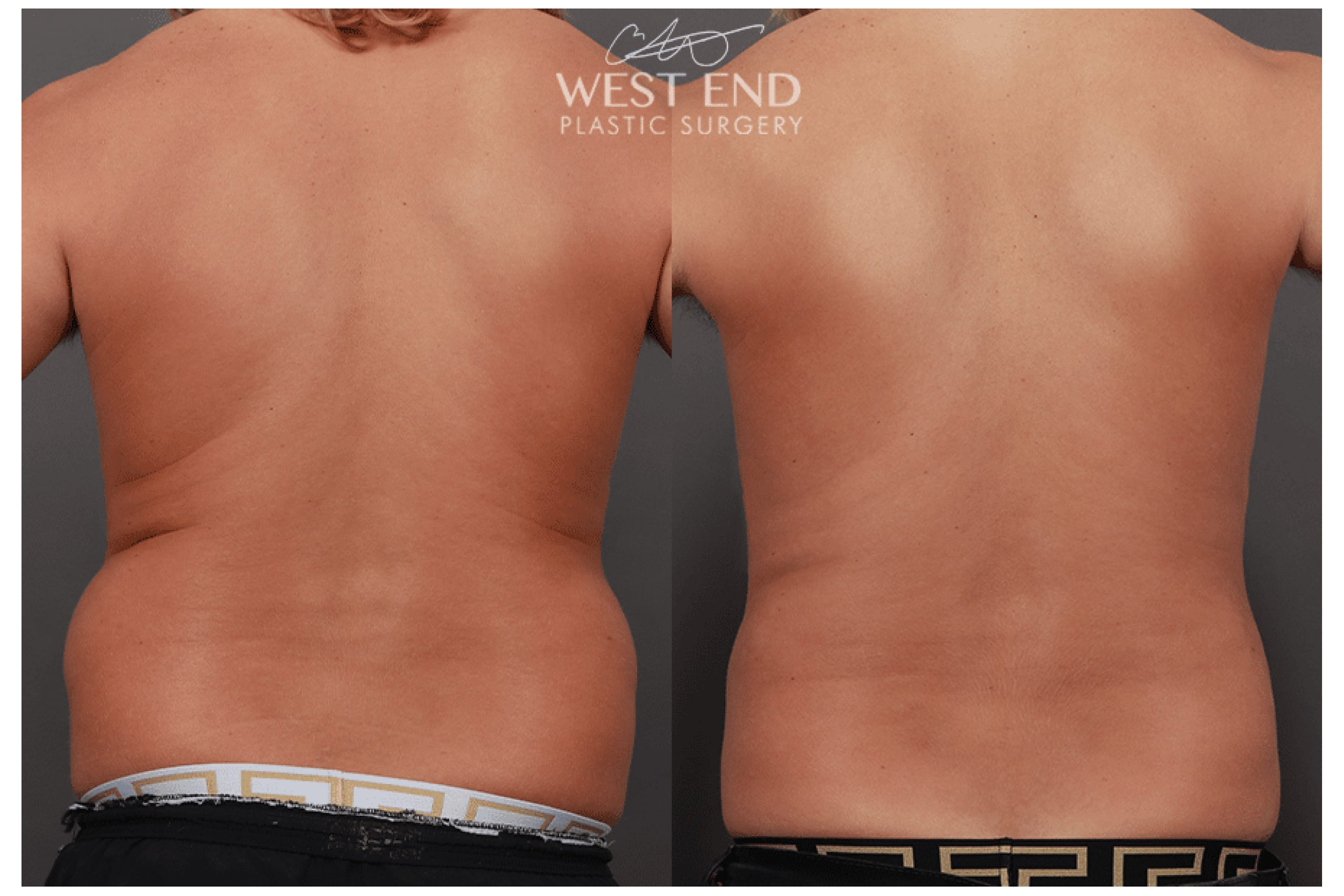 Liposuction and Renuvion Skin Tightening (6 Months Post-Op)