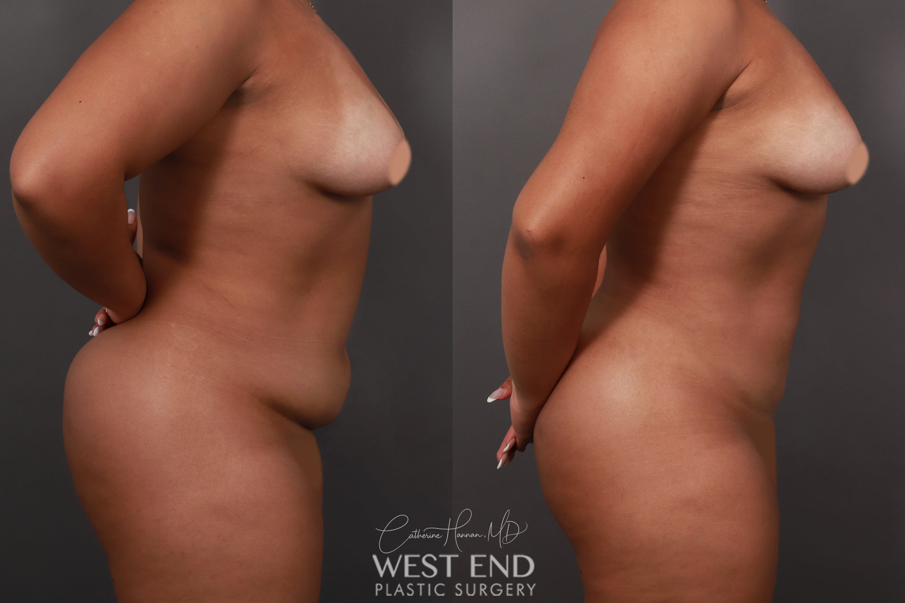 Liposuction and Renuvion Skin Tightening