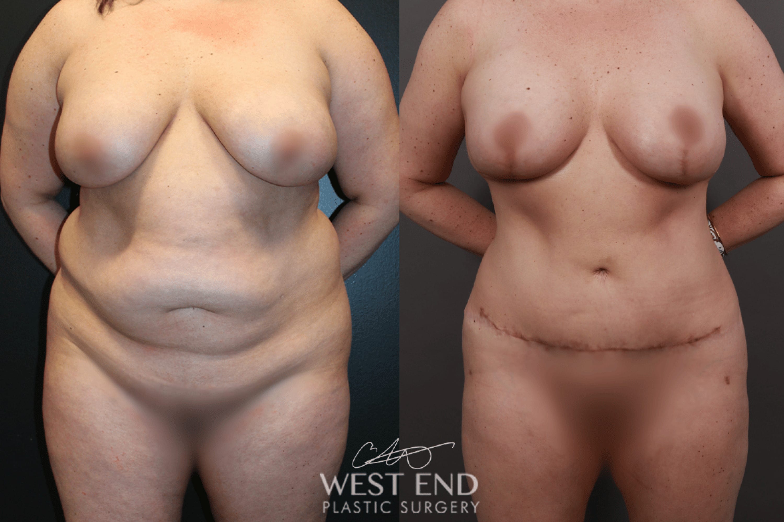 Post Weight Loss: Tummy Tuck, Liposuction, Renuvion Skin Tightening, and a Breast Lift with Implant Exchange