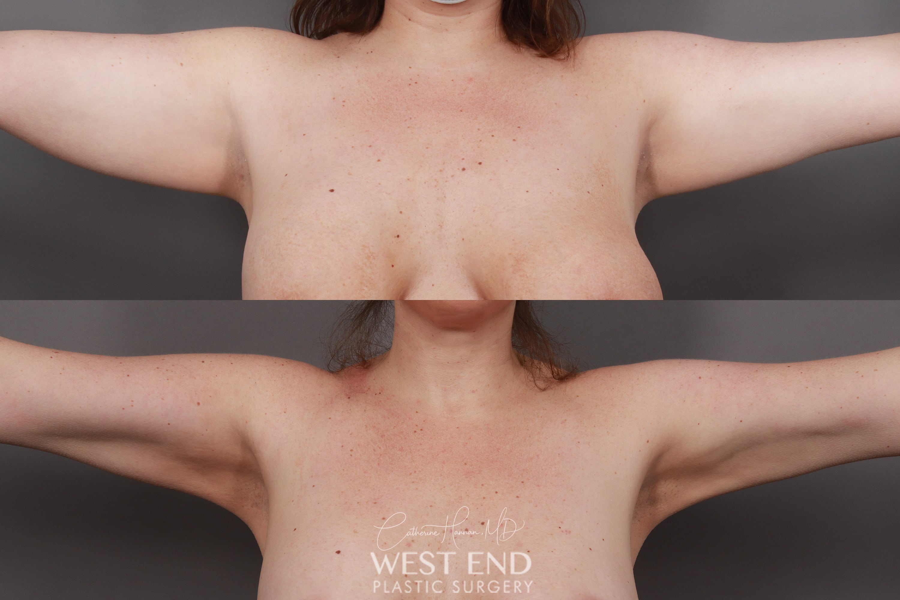 Liposuction and Renuvion Skin Tightening