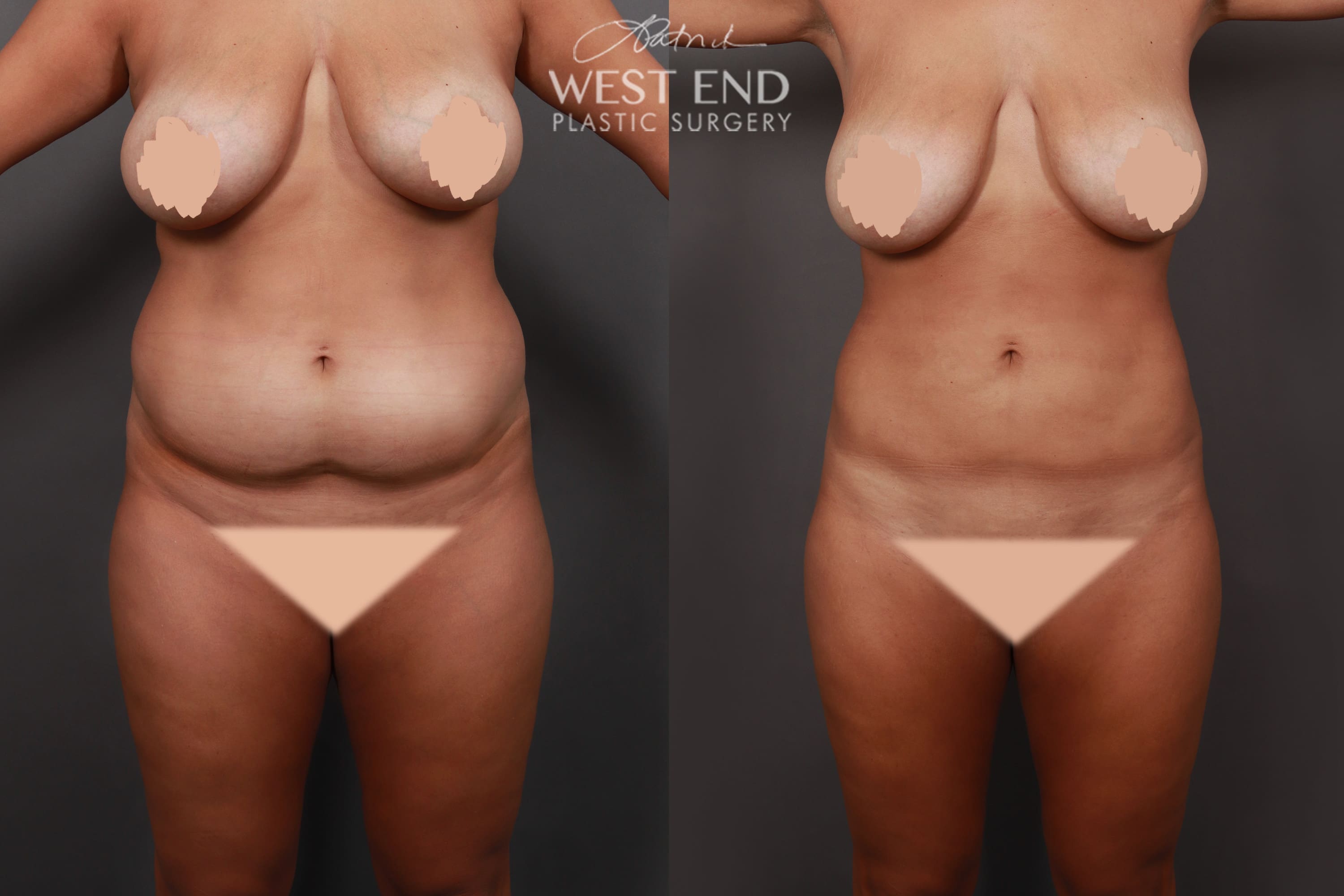 Liposuction (7 Months Post-Op)