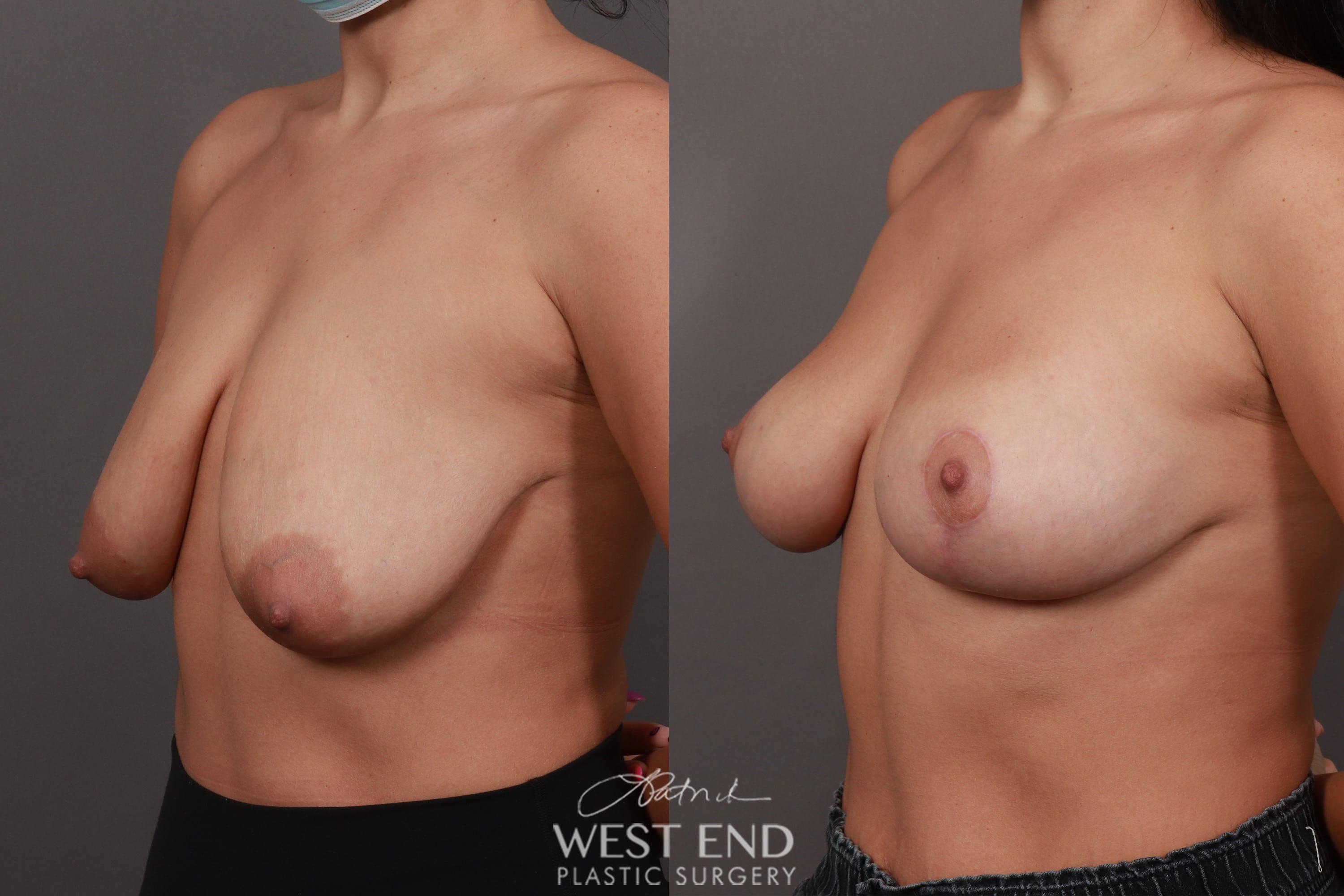Breast Lift (2.5 Months Post-Op)