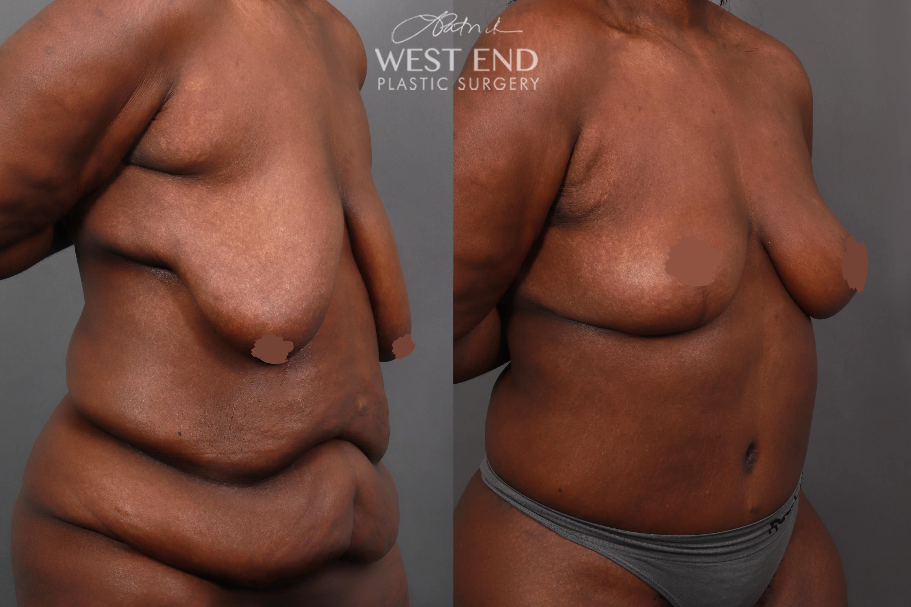 Post Weight Loss: Breast Lift, Tummy Tuck, and Liposuction (5 Months Post-Op)